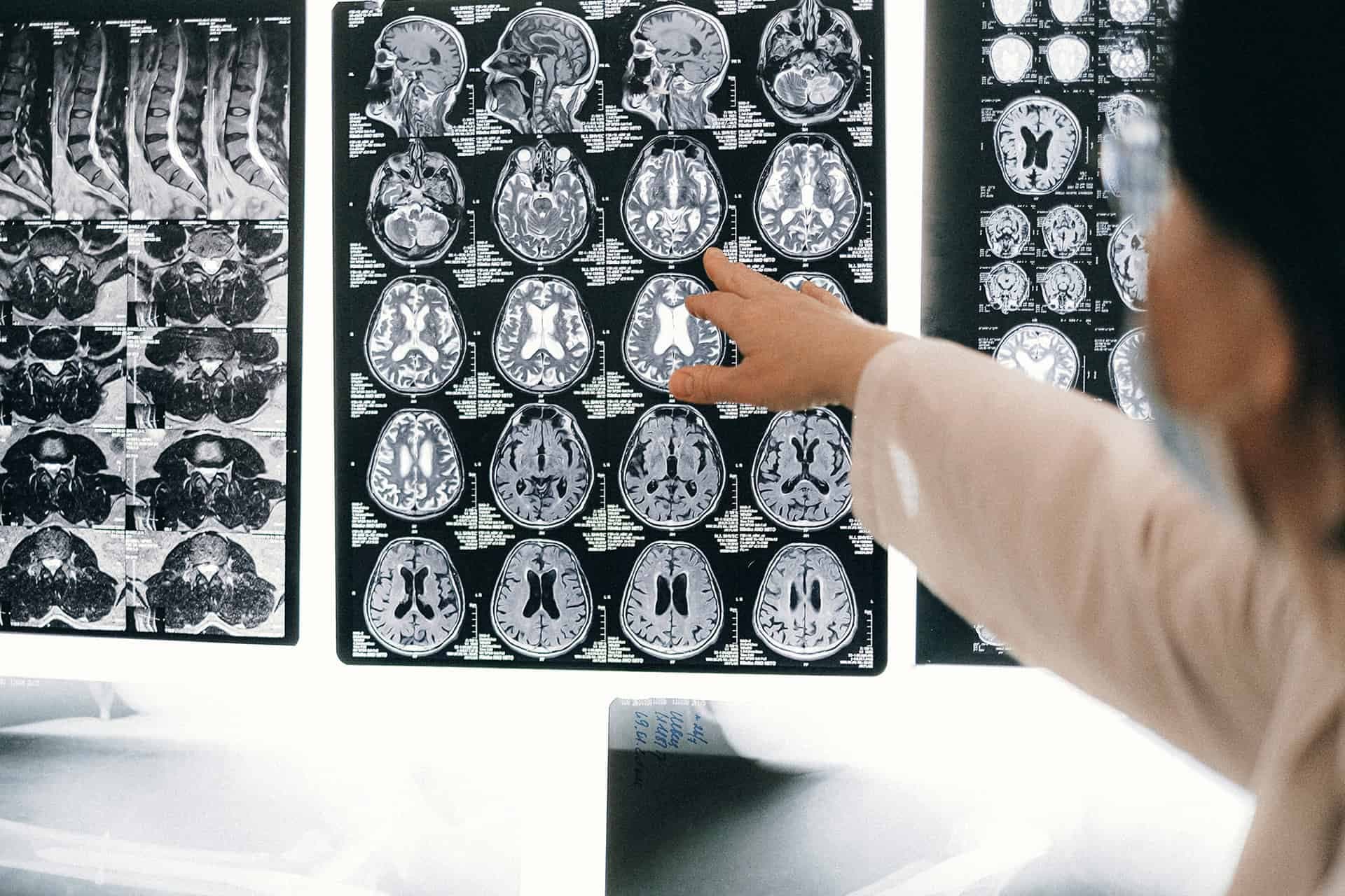 En läkare som pekar på skiktröntgenbilder av en persons hjärna.