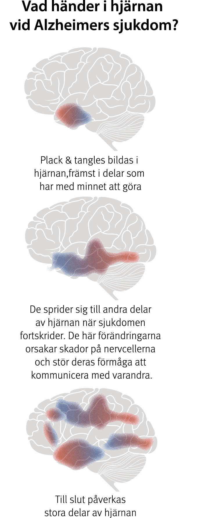 Alzheimers sjukdom idag | Hjärnfonden