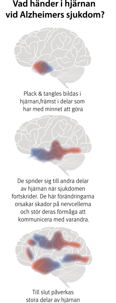 Alzheimers Sjukdom Idag | Hjärnfonden